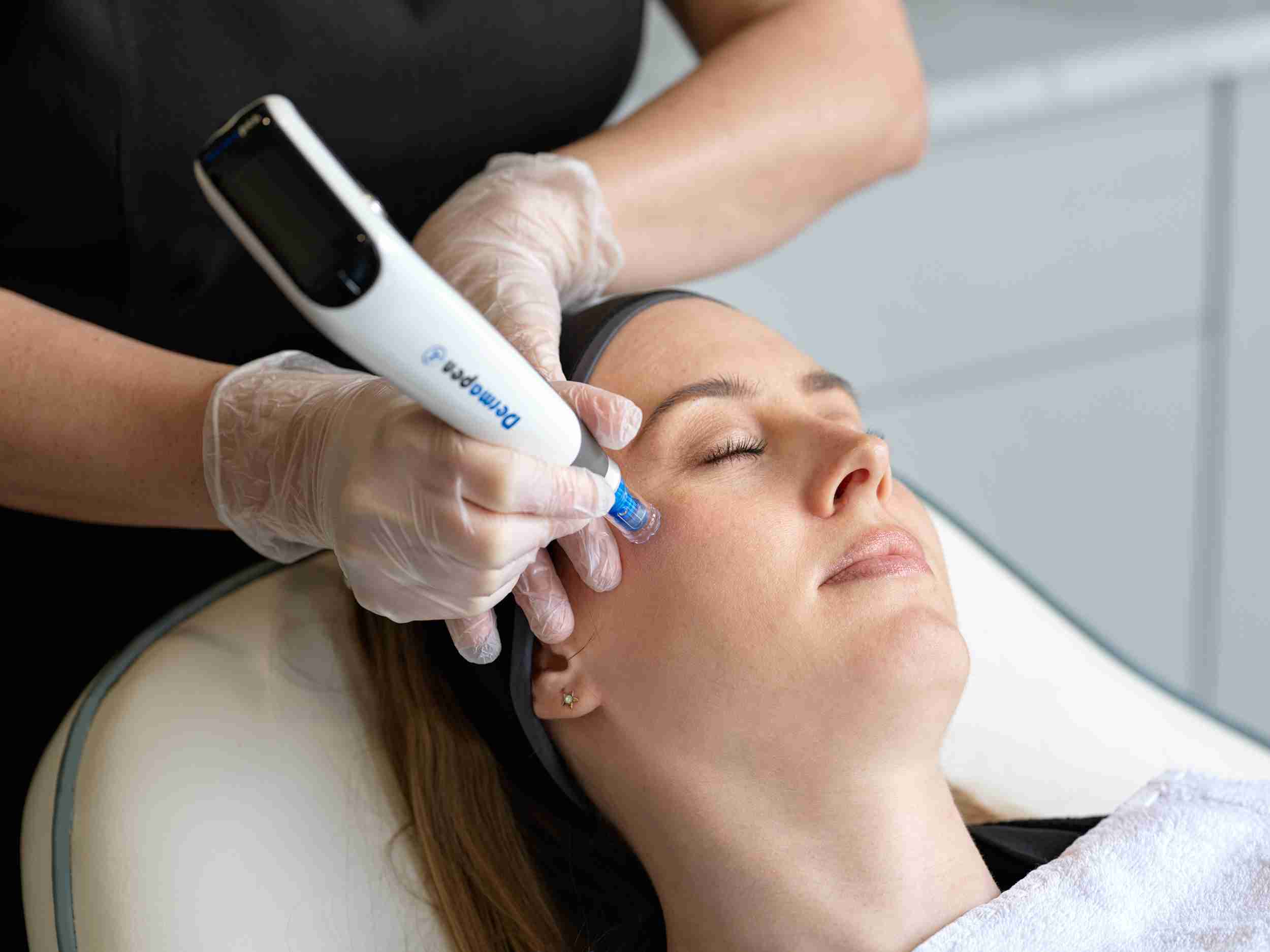 Can Dermapen Treatment Remove Acne Scars?