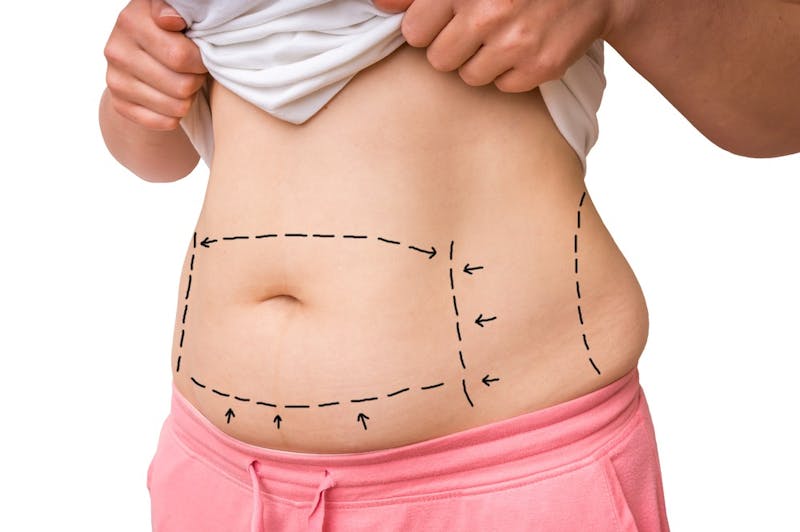 How Does a Tummy Tuck Differ from Liposuction?