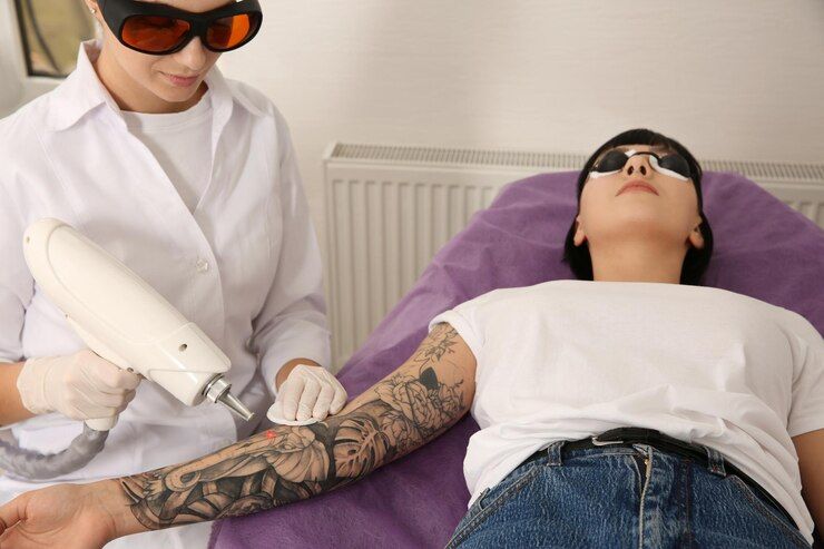 How Many Sessions Do You Need for Laser Tattoo Removal?