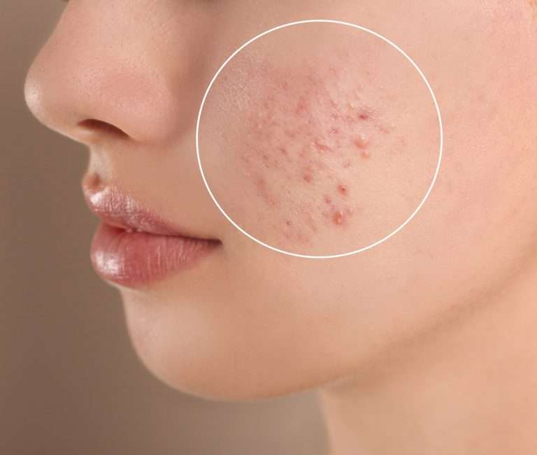 What Are the Best Treatments for Acne Scars?