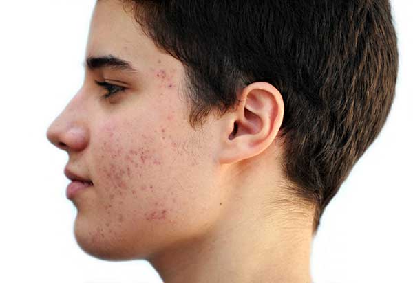 Are Acne Scar Treatments Safe for Kids?