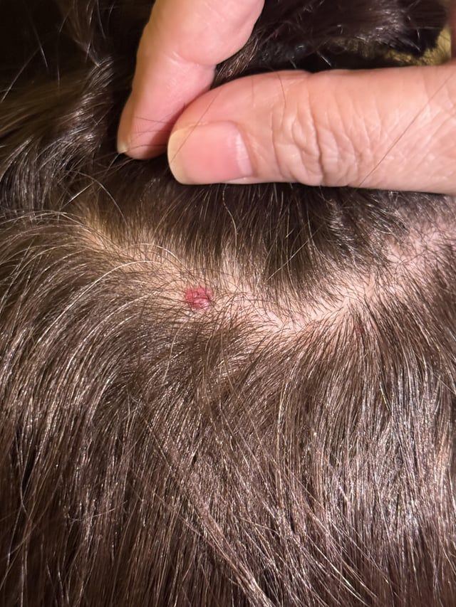 Are Moles on the Scalp Safe to Remove?