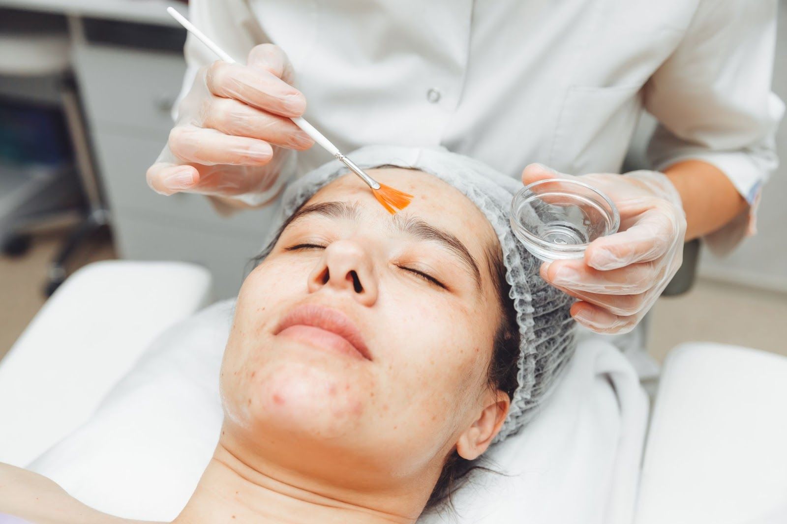 Are Peels Good for Dark Spots on the Face?