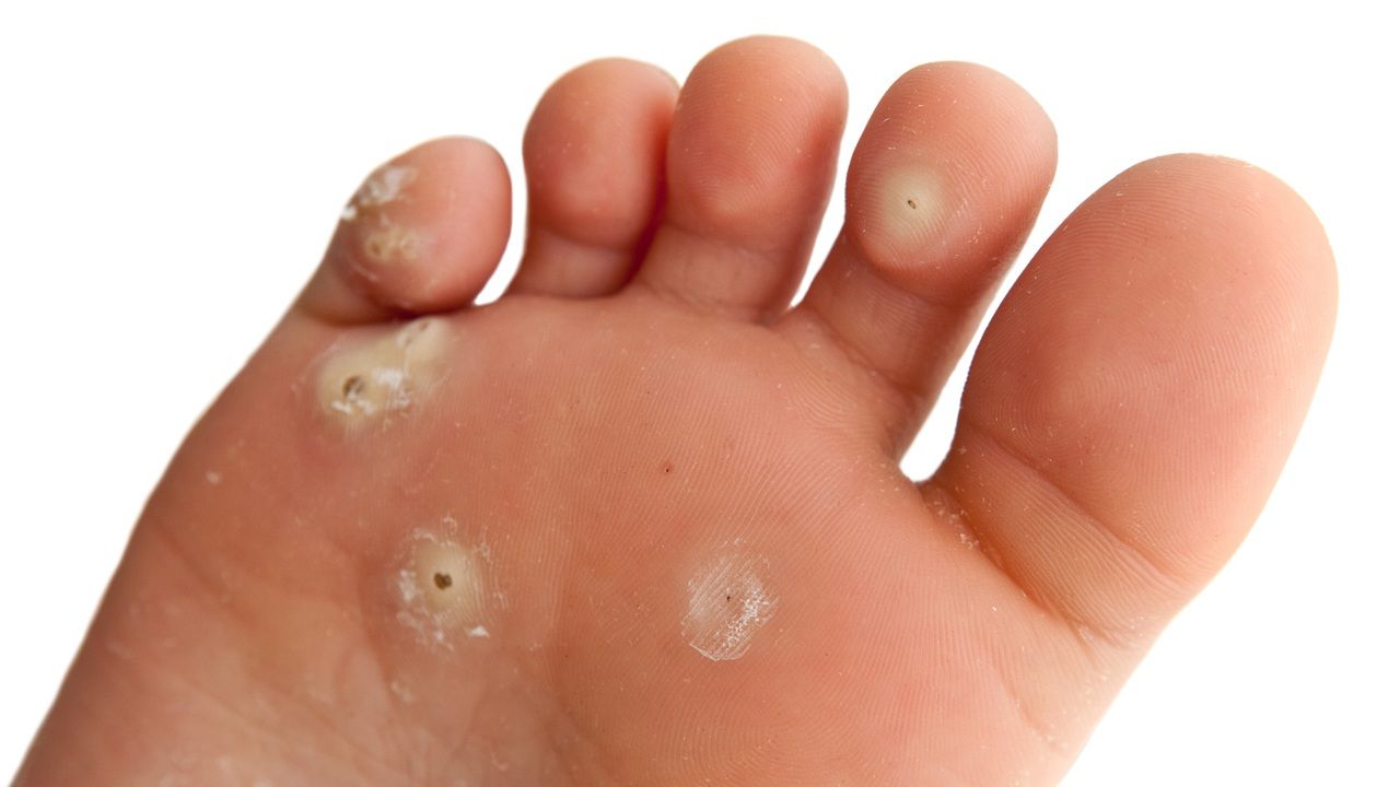Can Warts Develop From Skin Injuries?