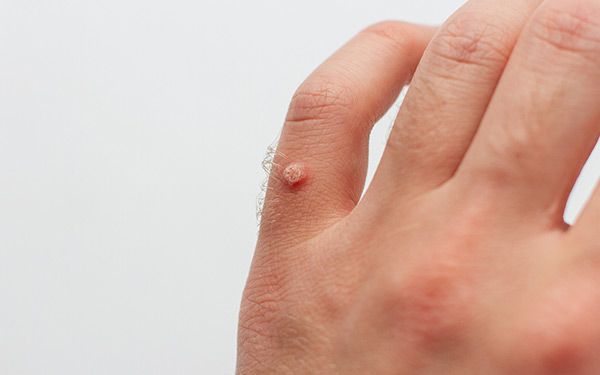 Can Warts Develop From Skin Injuries?