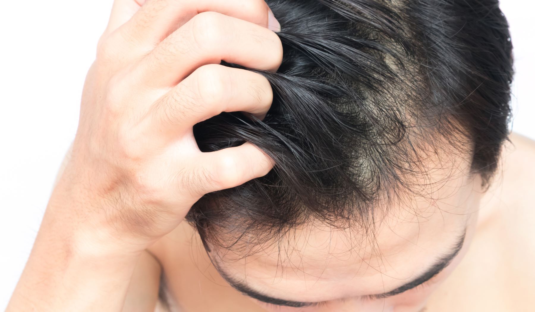 Do Hair Transplants Work on Receding Hair?