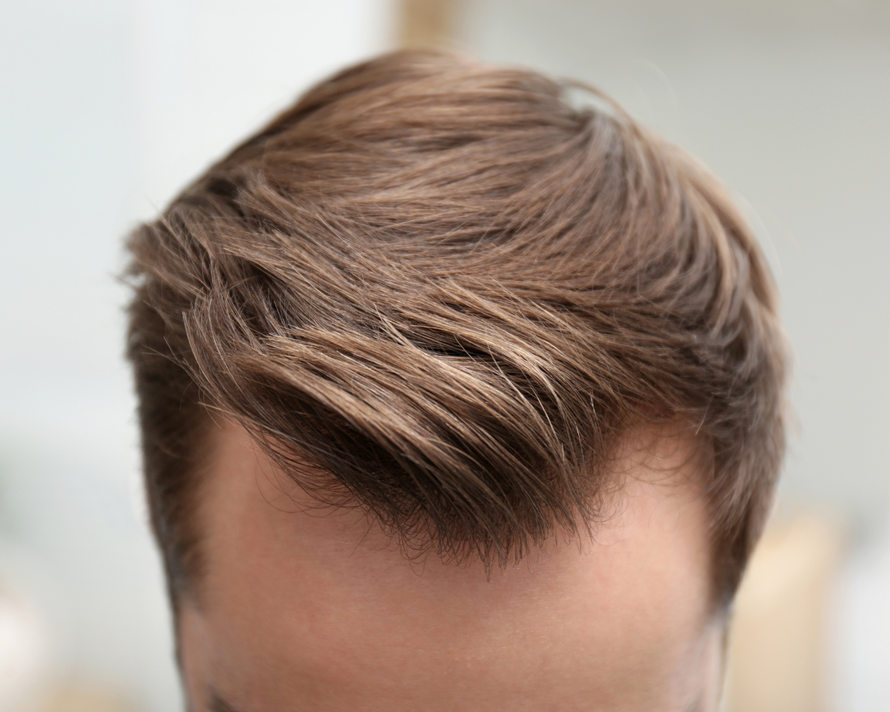 Do Hair Transplants Work on Receding Hair?