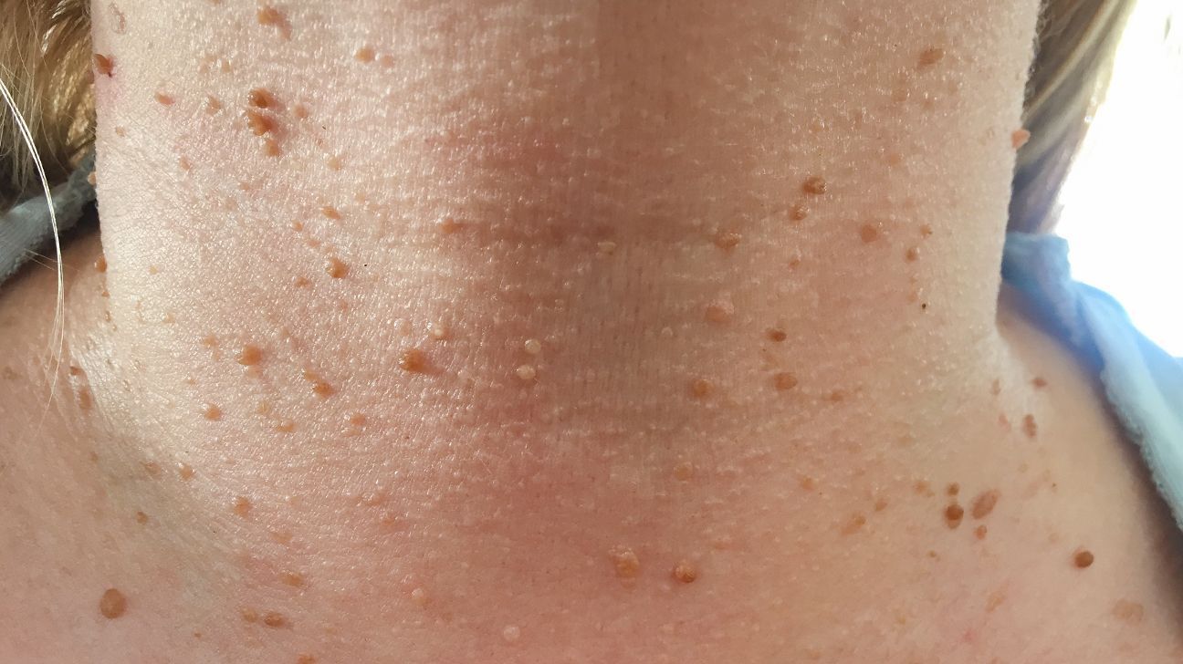Does Skin Tag Removal Work on All Body Areas?