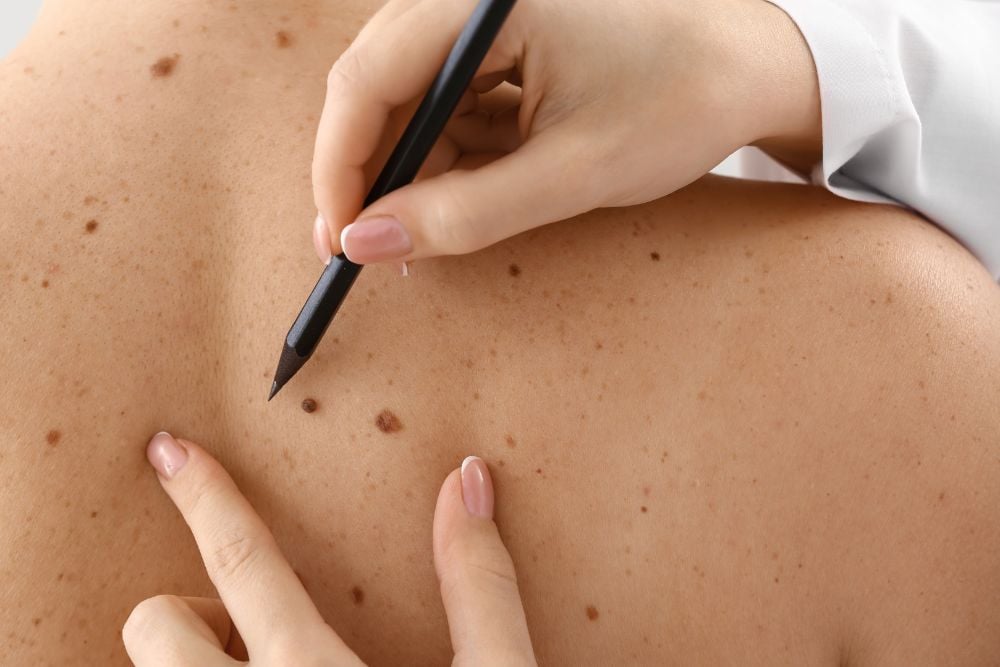 Does Skin Tag Removal Work on All Body Areas?