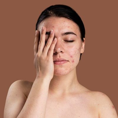 How to Treat Acne Scars on Oily Skin?