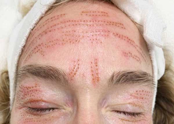 Is Plasma Pen Good for Forehead Wrinkles?