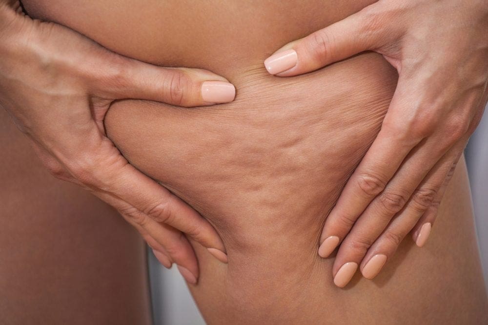 Is Cellfina Treatment Good for Cellulite Removal?