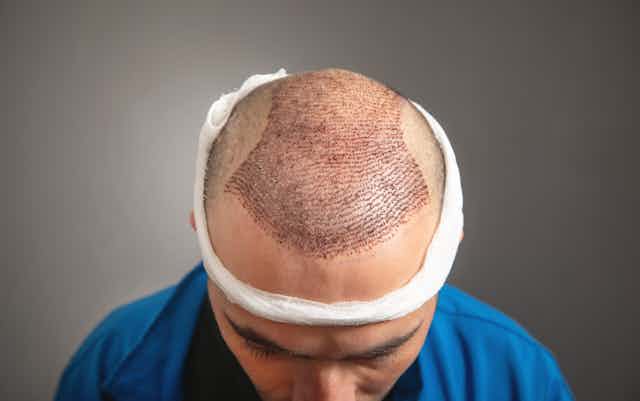 Who Is a Good Candidate for a Hair Transplant?
