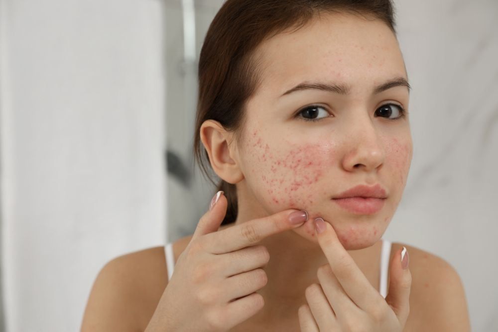 What Is The Best Pimples Treatment For Oily Skin?